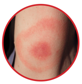 Bulls eye rash Bulls eye rash